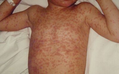 Measles Exposure Reported in Halifax