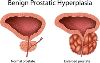 Do You Have Prostate Issues?